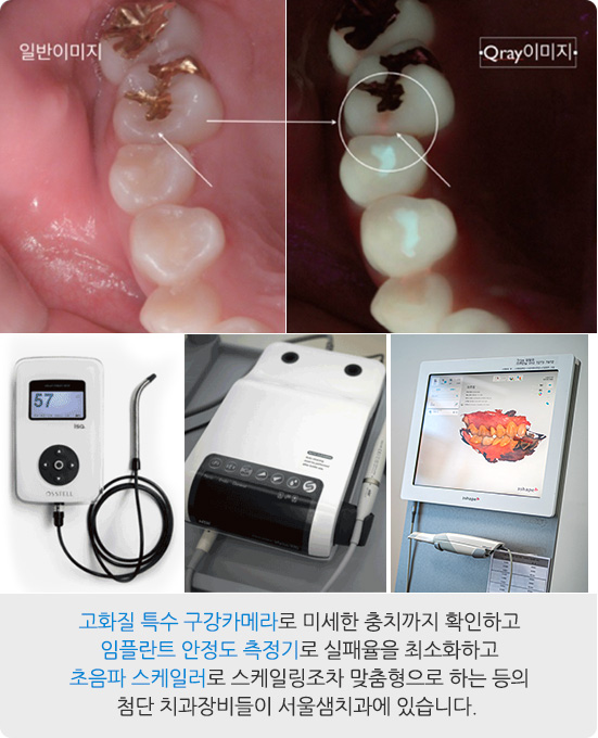 고화질 특수 구강카메라로 미세한 충치까지 확인하고 임플란트 안정도 측정기로 실패율을 최소화하고 초음파 스케일러로 스케일링조차 맞춤형으로 하는 등의 첨단 치과장비들이 서울샘치과에 있습니다.