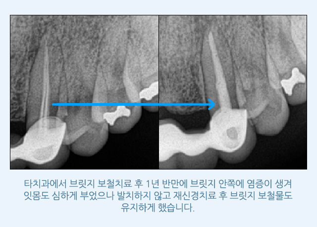 서울샘의 임플란트?