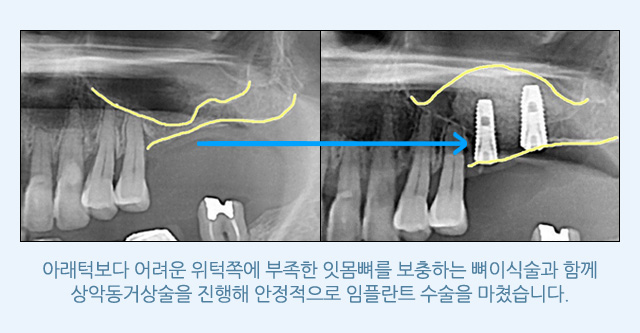 서울샘의 임플란트?