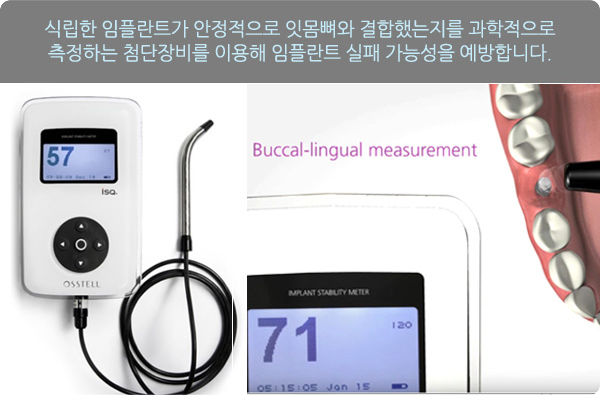 서울샘의 임플란트?