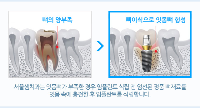 뼈이식 임플란트