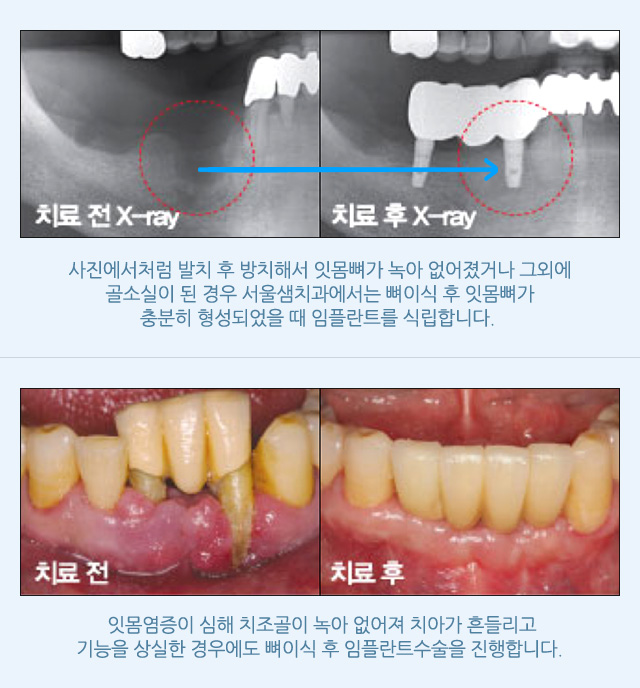 뼈이식 임플란트