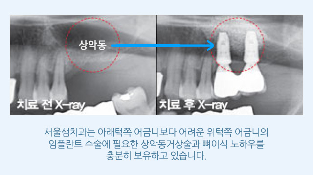 상악동 임플란트