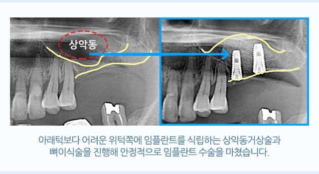 상악동 임플란트