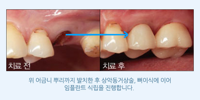 상악동 임플란트
