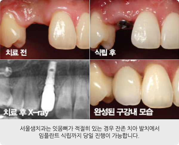 당일 식립 임플란트