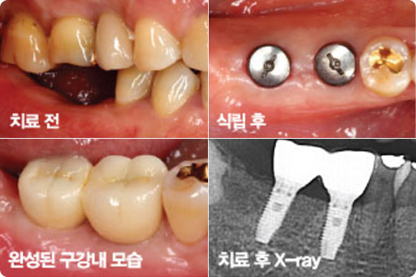 당일 식립 임플란트