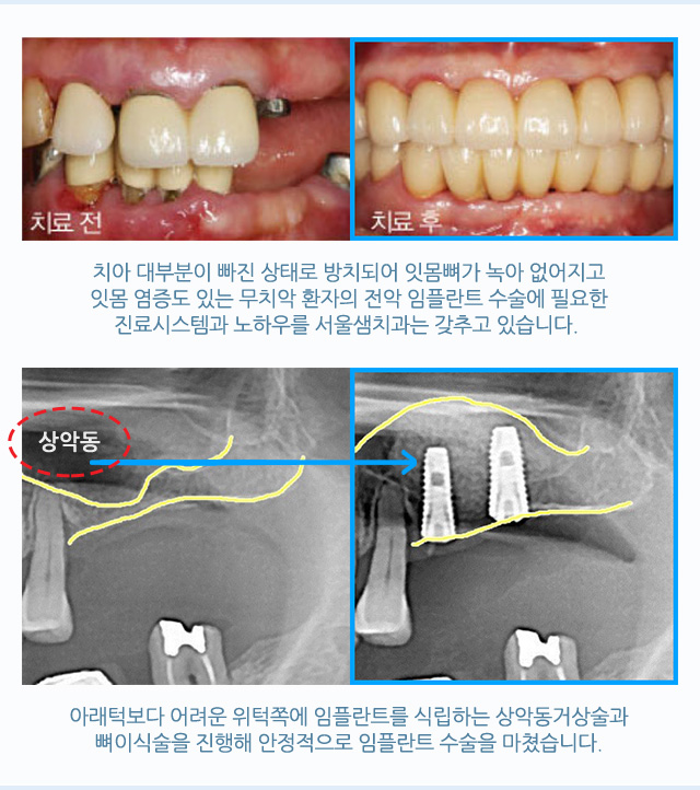 전체 임플란트