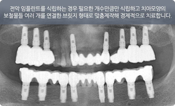 전체 임플란트
