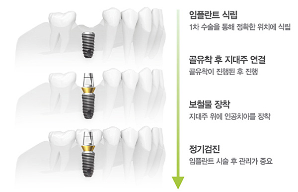 보험 임플란트