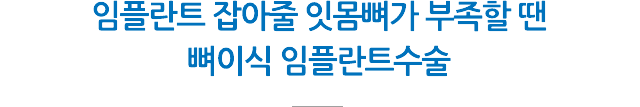뼈이식 임플란트