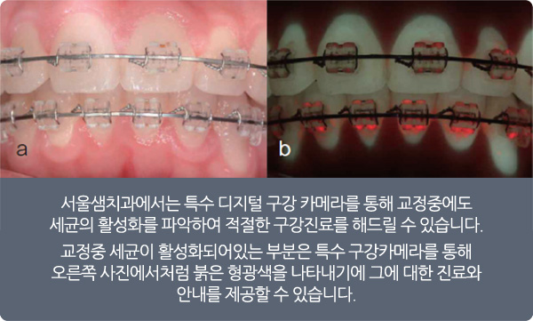 서울샘의 교정치료?