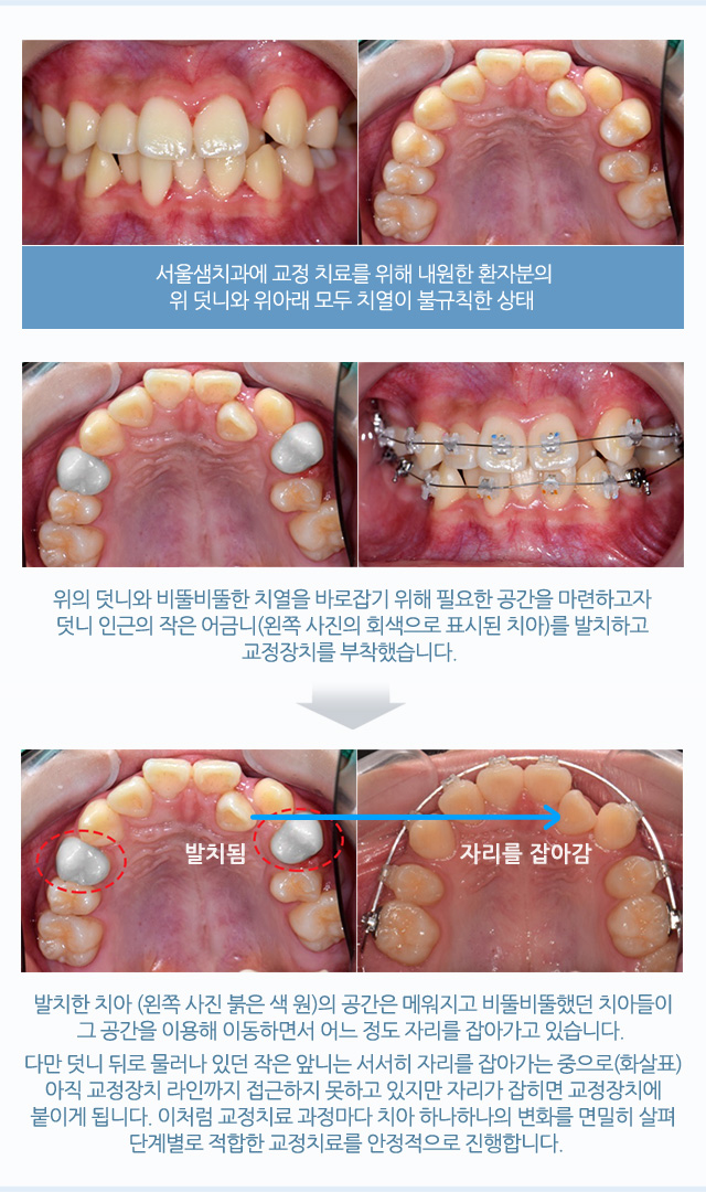 덧니교정