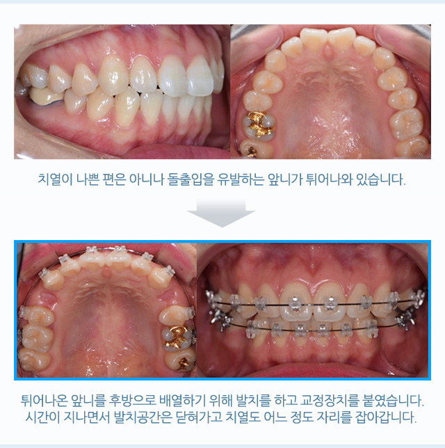 돌출입 교정