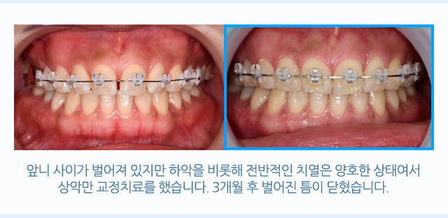벌어진 치아/개방교합