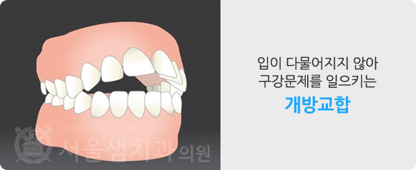 벌어진 치아/개방교합