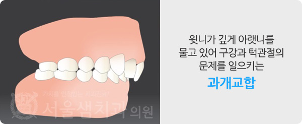 벌어진 치아/개방교합
