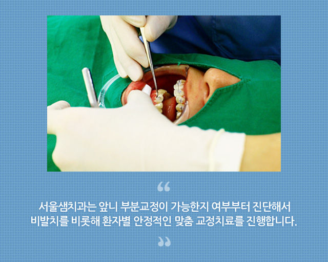 앞니 부분 교정