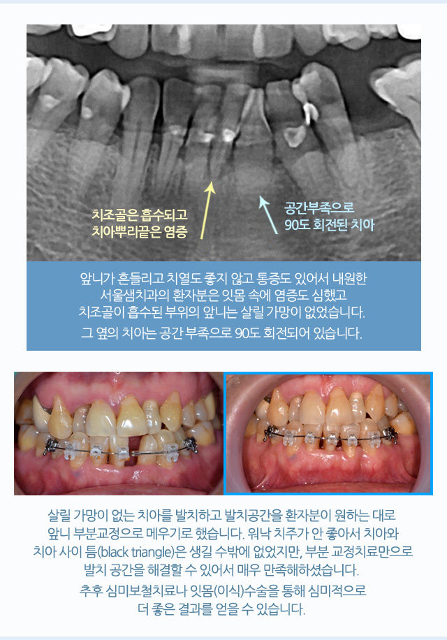 앞니 부분 교정
