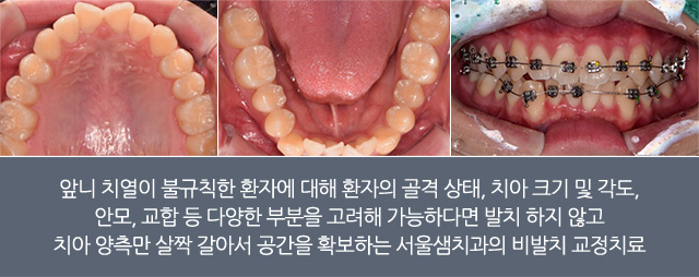 비발치 교정