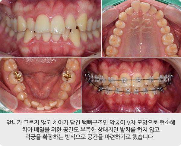 비발치 교정