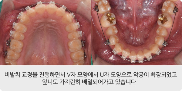 비발치 교정