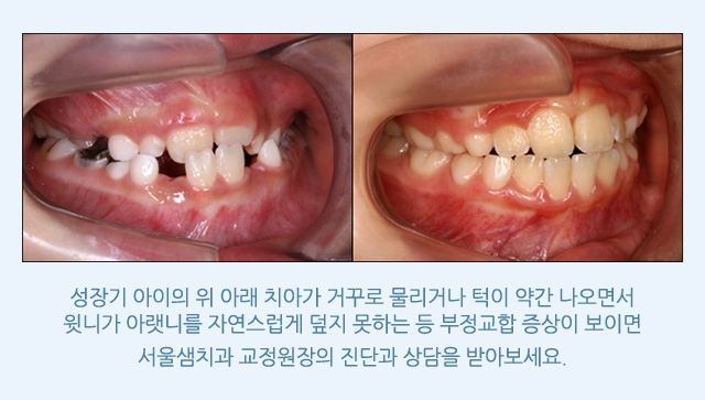 성장기 교정