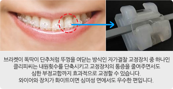 교정장치 안내