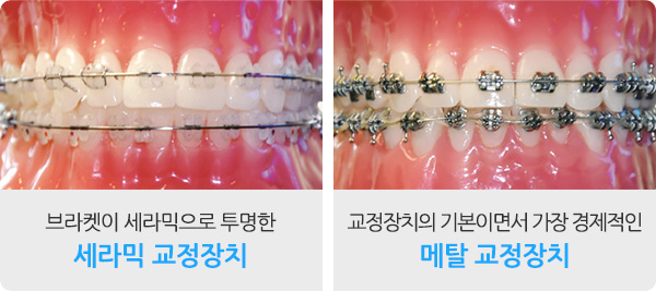 교정장치 안내