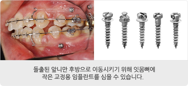 교정장치 안내