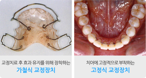 교정장치 안내