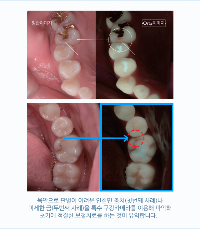 서울샘의 보철치료?