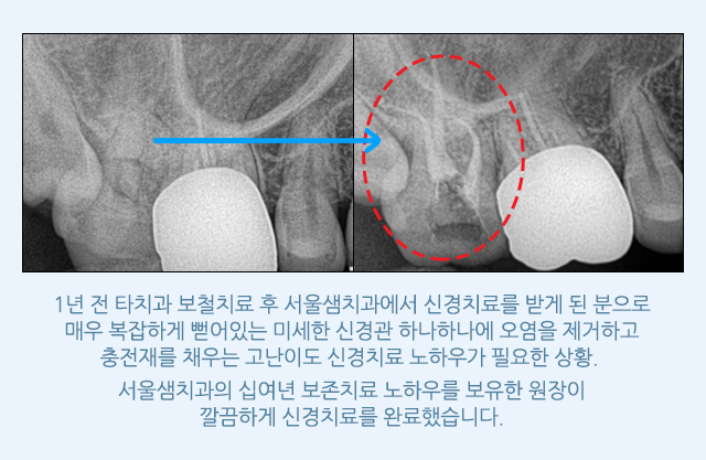 서울샘의 보철치료?