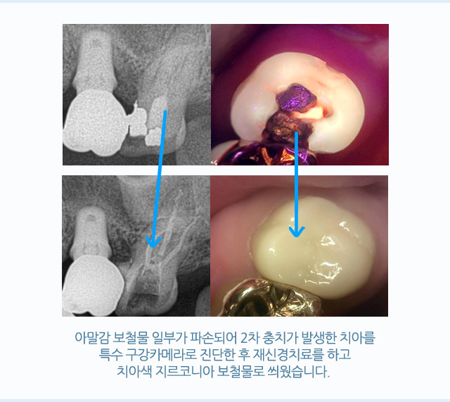 서울샘의 보철치료?