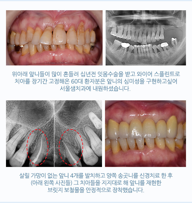 브릿지
