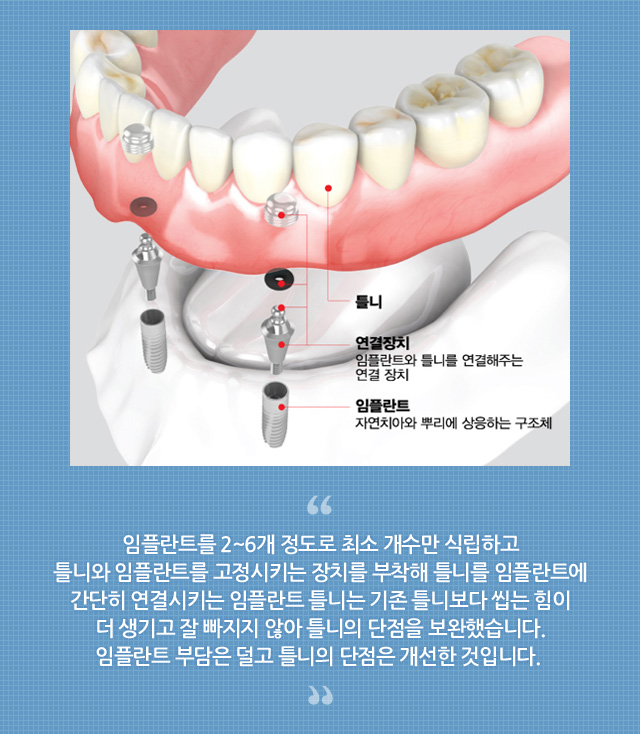 임플란트 틀니, 틀니