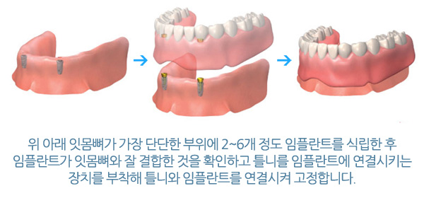 임플란트 틀니, 틀니