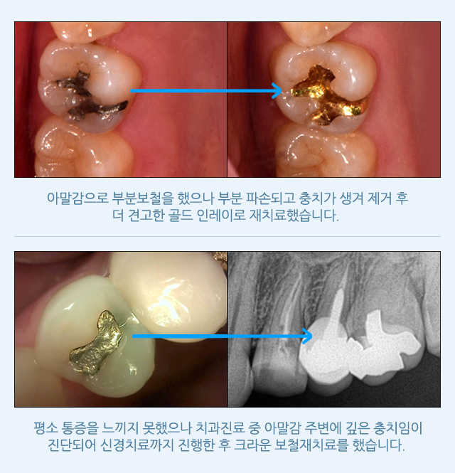 보철 재치료