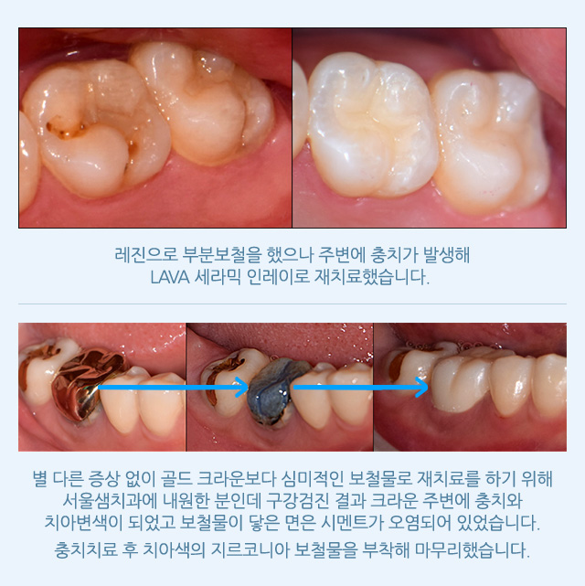 보철 재치료