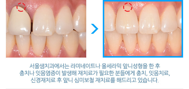 서울샘의 심미치료?