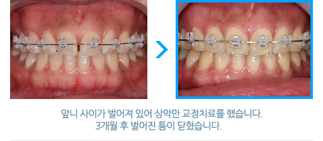 서울샘의 심미치료?