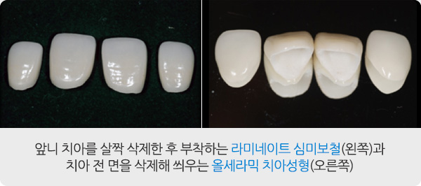 앞니성형/재치료