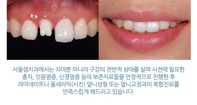 앞니성형/재치료