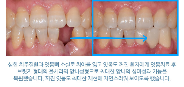 앞니성형/재치료