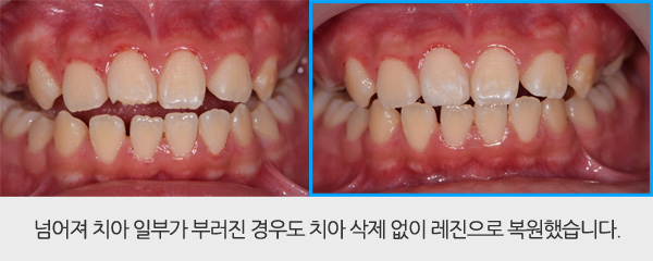 레진 치아성형