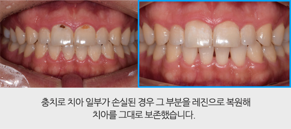 레진 치아성형