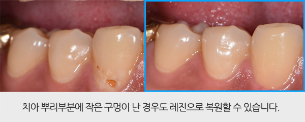 레진 치아성형
