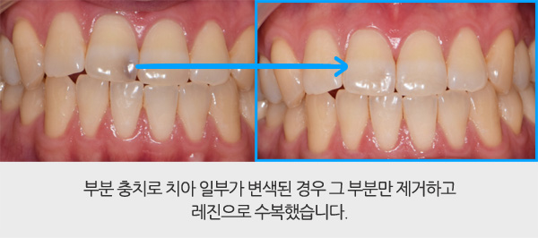 레진 치아성형