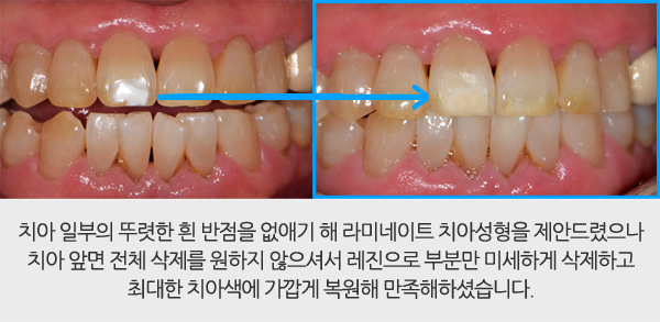 레진 치아성형