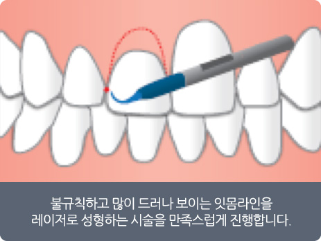 치아미백, 잇몸성형